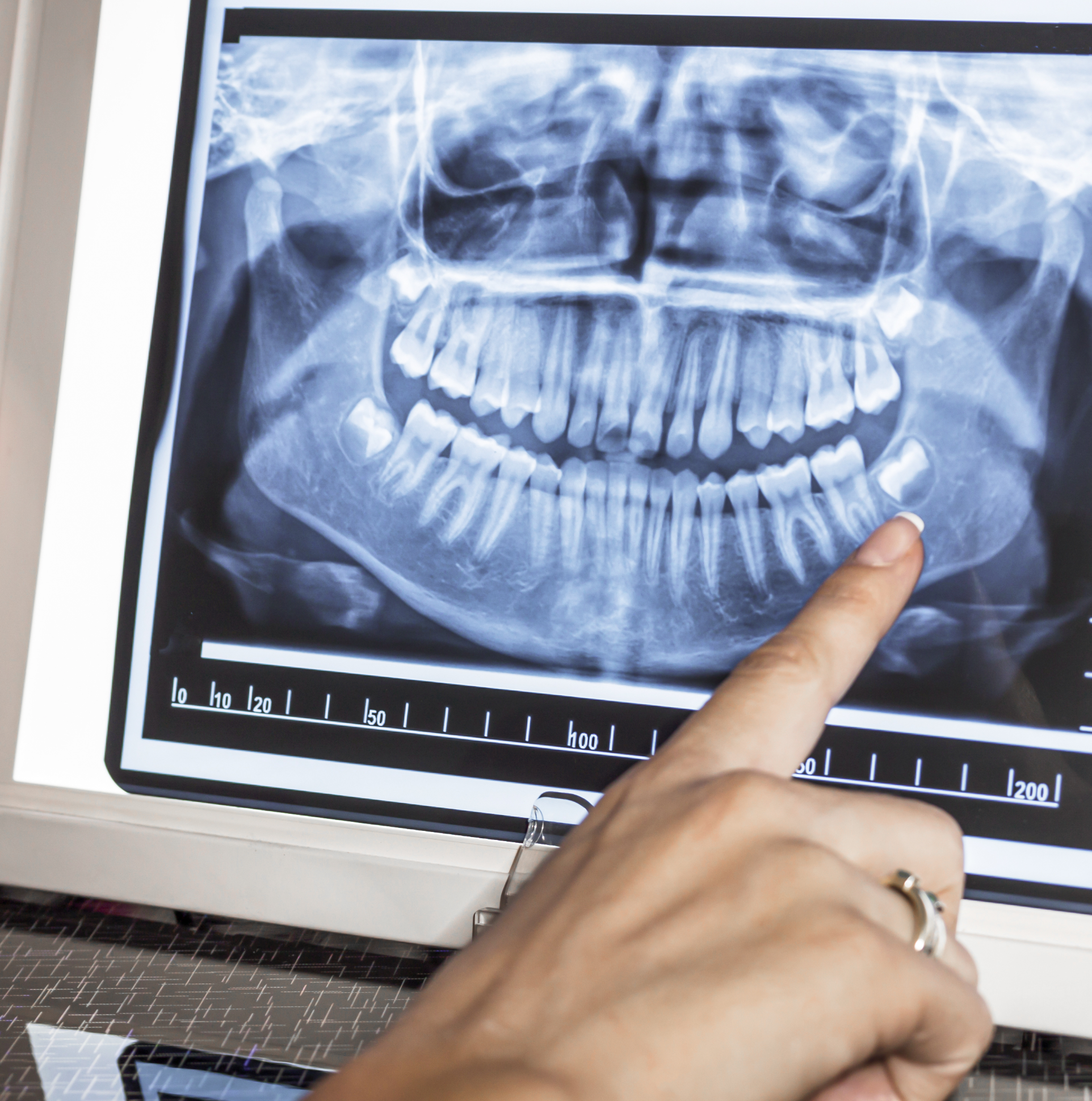 O que é a Disfunção Temporomandibular?